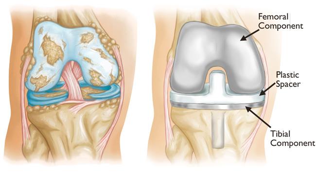 INSTRUCTONS FOR KNEE REPLACEMENT